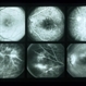 Eales Disease Eales Disease
